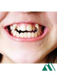 Răng nanh có khả năng giảm chấn động khi nhai hay không? 
